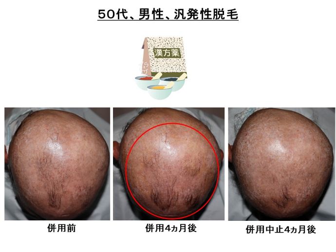 円形脱毛症　病院